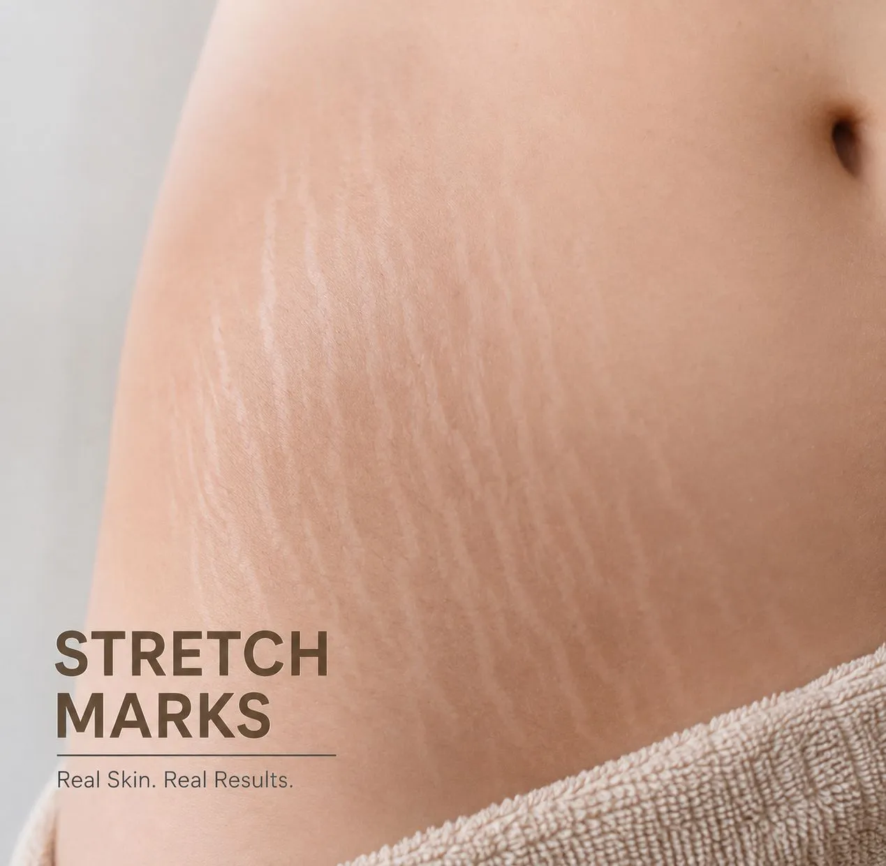 Stretch marks