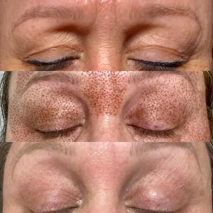 Lifting Lymphatic Drainage