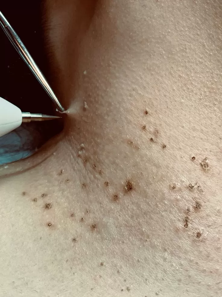 Lifting Lymphatic Drainage
