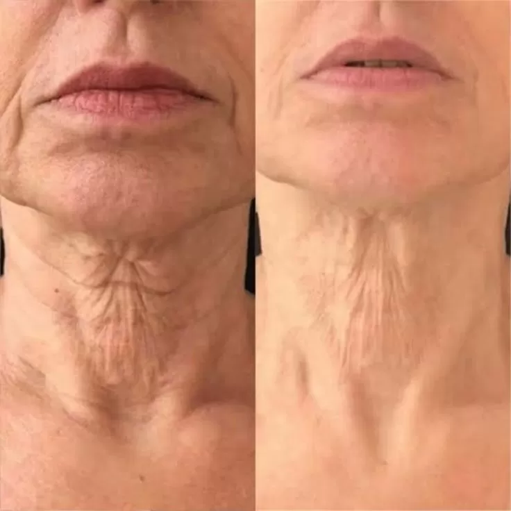 Lifting Lymphatic Drainage