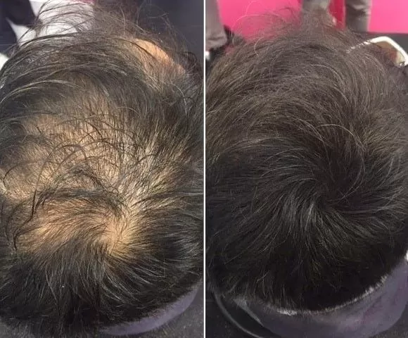 Lifting Lymphatic Drainage