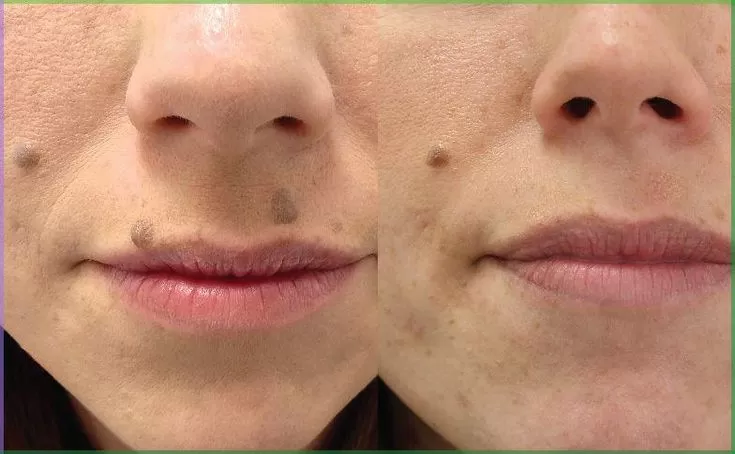 Lifting Lymphatic Drainage